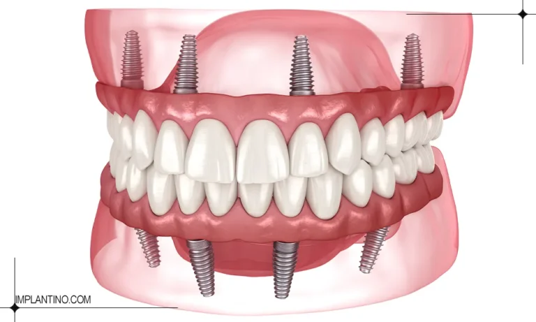 عکس ایمپلنت فول فک یا فول موس