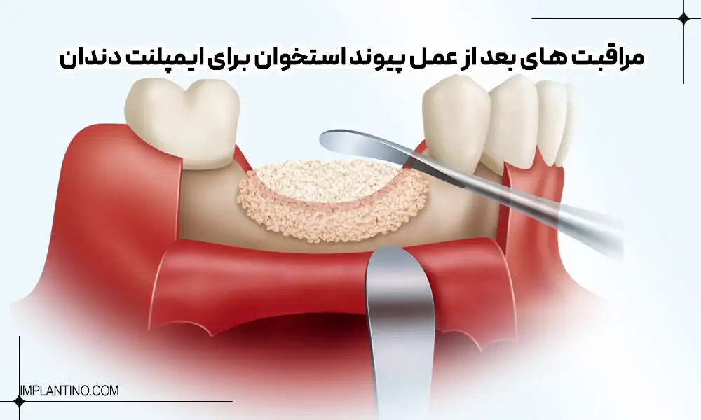 چه زمانی جراحی پیوند استخوان برای ایمپلنت انجام می شود؟ 4 Postoperative care for bone grafting for dental implants