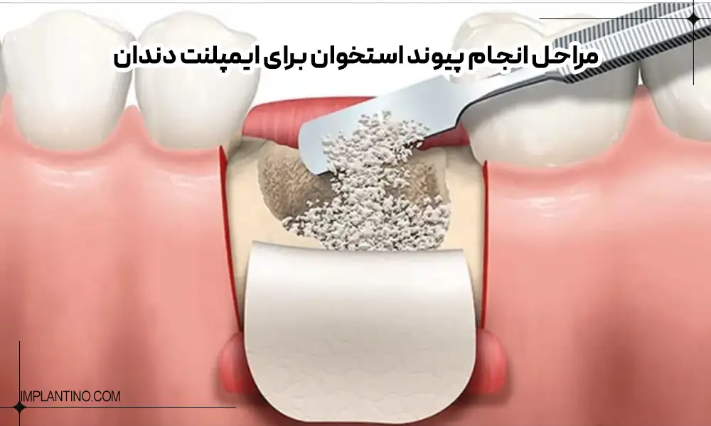 چه زمانی جراحی پیوند استخوان برای ایمپلنت انجام می شود؟ 2 Steps for performing bone grafting for dental implants