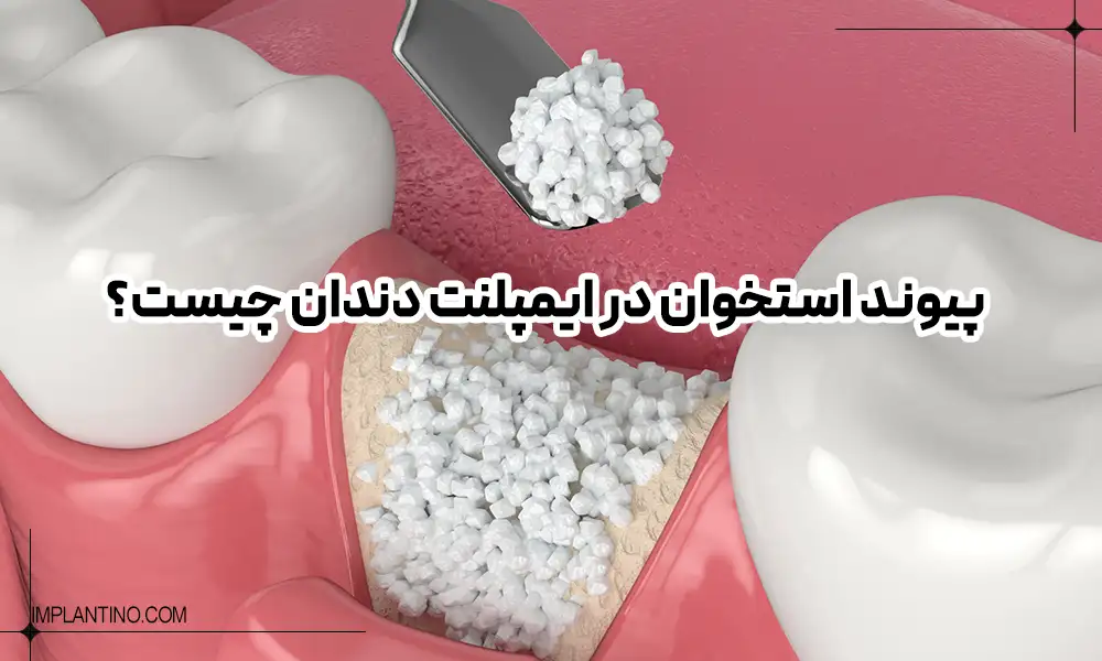 چه زمانی جراحی پیوند استخوان برای ایمپلنت انجام می شود؟ 1 What is bone grafting in dental implants