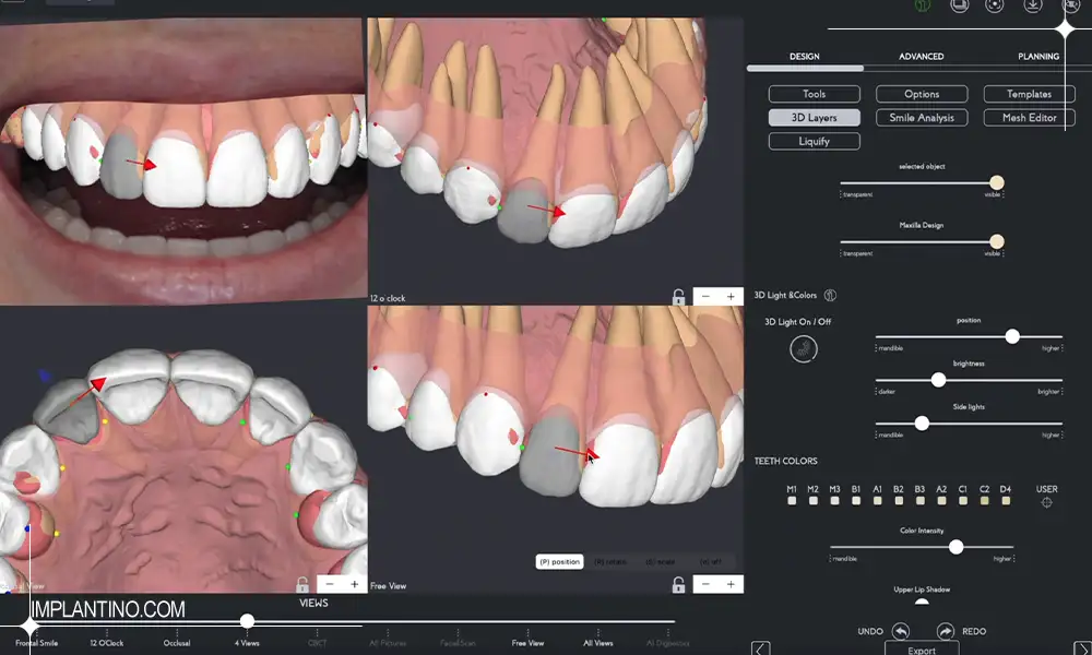 آشنایی با طراحی لبخند دیجیتال 3 طریقه طراحی لبخند دیجیتال