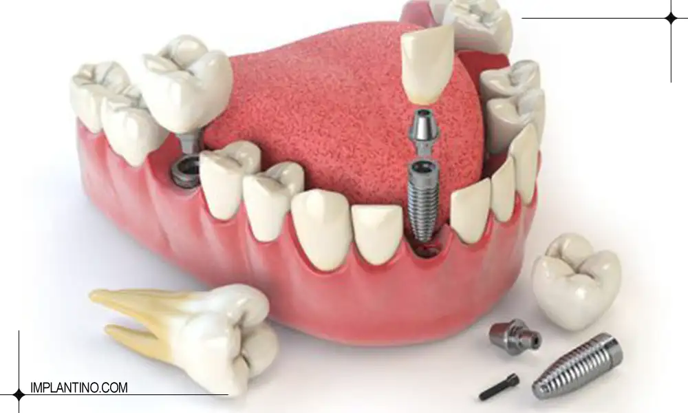 معرفی ایمپلنت cmi کره ای 2 کاشت ایمپلنت cmi