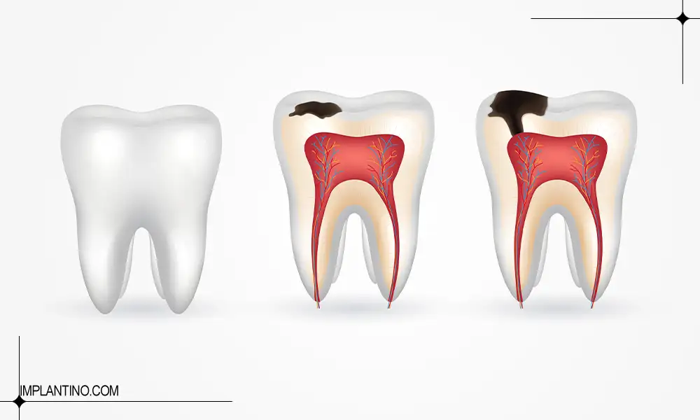 پوسیدگی دندان در سه مرحله