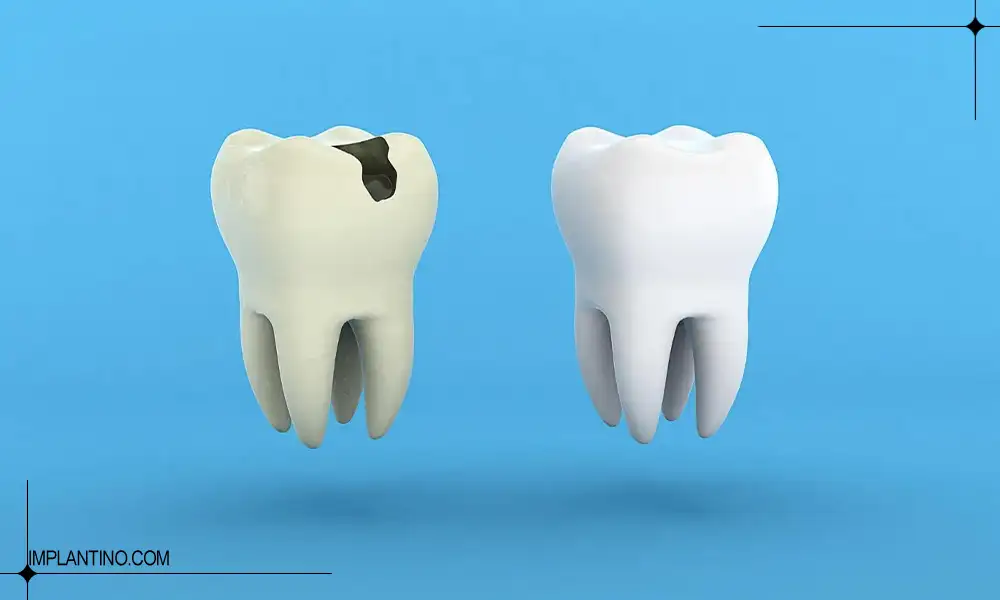 دندان سالم در کنار دندان خراب