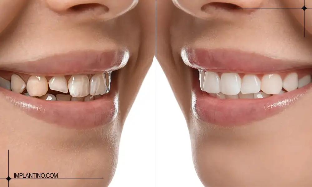 باندینگ دندان 3 قبل و بعد از باندینگ دندان