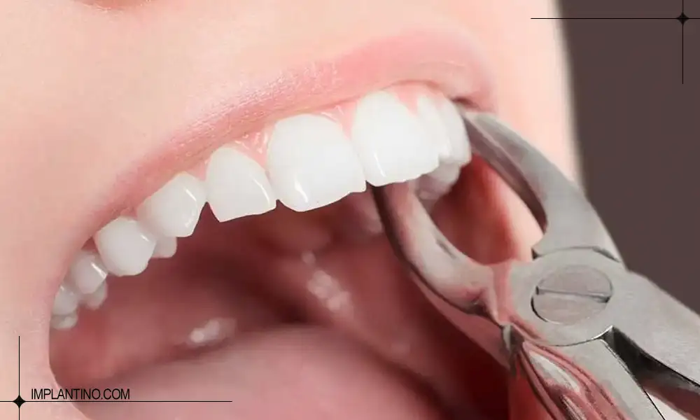 خونریزی بعد از کشیدن دندان و عکس کشیدن دندان