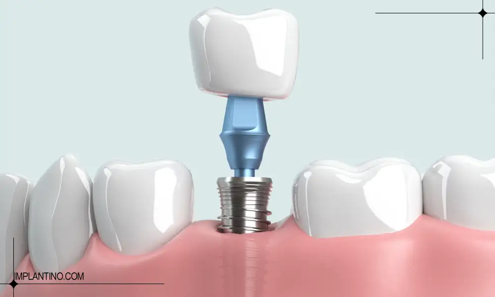 نصب ایمپلنت | عمر ایمپلنت دندان