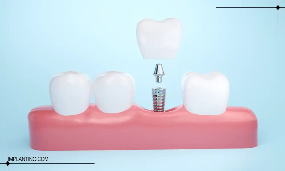 ترمیم ایمپلنت دندان امکان پذیر است؟ 3 عکس قرار گیری ایمپلنت | ترمیم ایمپلنت دندان