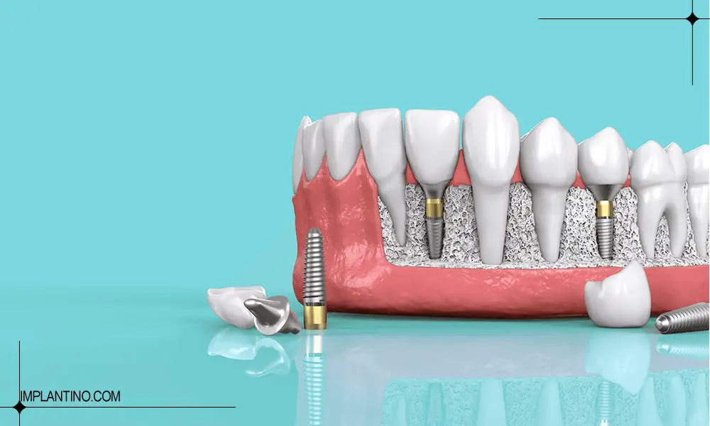 عکس ایمپلنت روی ماکت فک و کنار فک | عمر ایمپلنت دندان