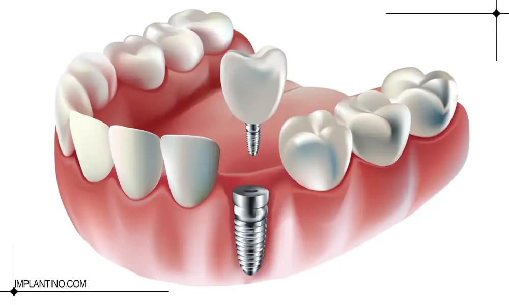 ترمیم ایمپلنت دندان امکان پذیر است؟ 2 عکس قرار دادن تاج ایمپلنت | ترمیم ایمپلنت دندان