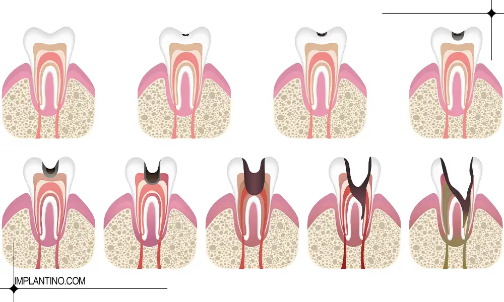 نحوه پوسیدگی دندان از سالمی تا خرابی دندان