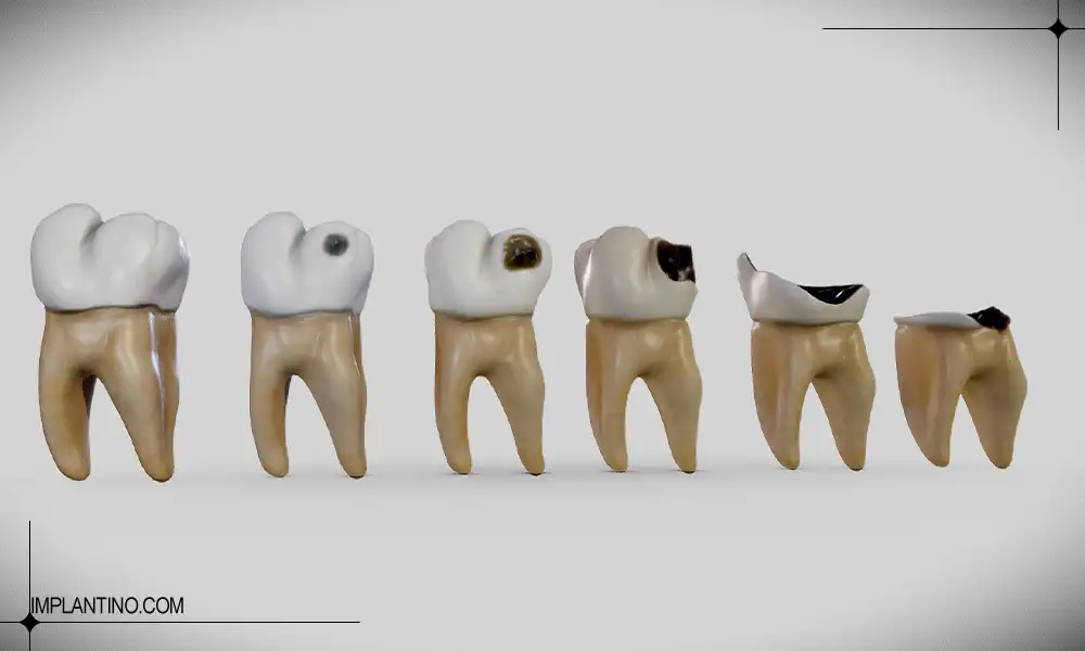 روند پوسیدگی دندان