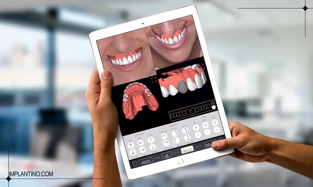 آشنایی با طراحی لبخند دیجیتال 2 نحوه طراحی لبخند دیجیتال