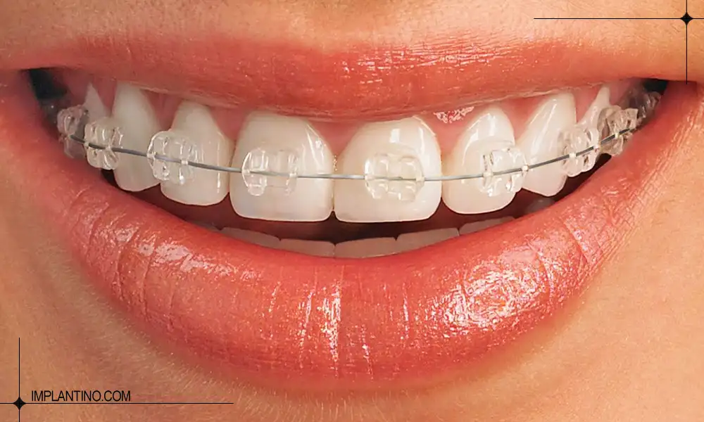 ارتودنسی دندان شفاف در دهان یک خانم