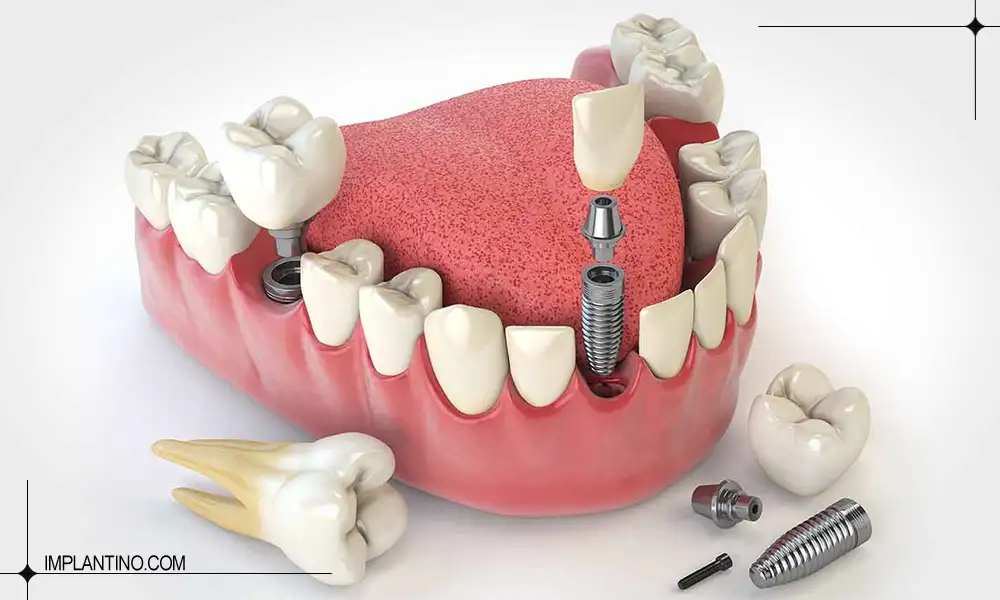ایمپلنت CIS کره ای | بررسی کامل ویژگی ها و مزایای CIS 1 کاشت ایمپلنت CIS کره ای