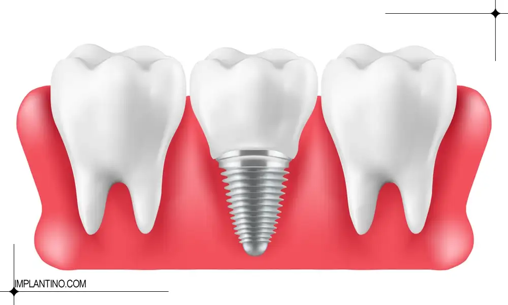ترمیم ایمپلنت دندان امکان پذیر است؟ 1 عکس انیمیشنی ترمیم ایمپلنت دندان