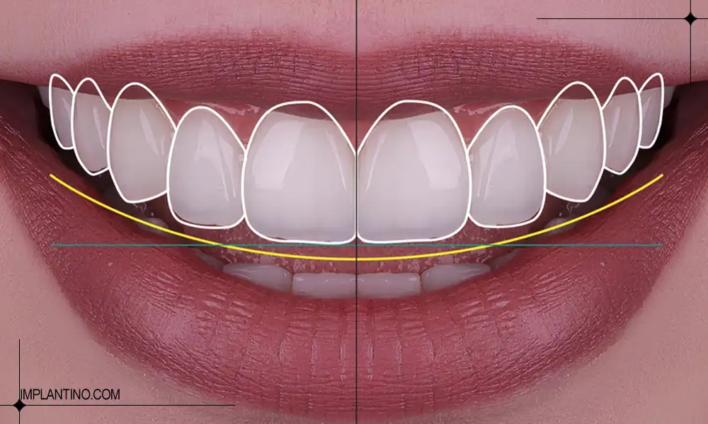 آشنایی با طراحی لبخند دیجیتال 1 لبخندی زیبا با دندان های سالم یک دست در طراحی لبخند دیجیتال