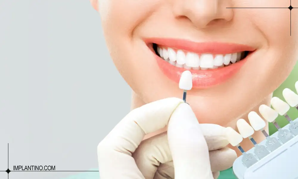 نمونه کامپوزیت شیشه ای دندان