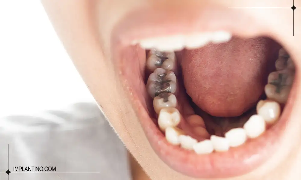 دلایل سیاه شدن دندان ها و راه های درمان 3 سیاه شدن دندان های پر شده و عصب کشی شده