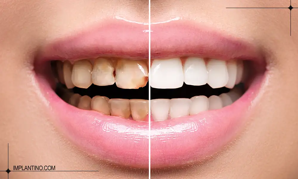 دلایل سیاه شدن دندان ها و راه های درمان 2 سیاه شدن دندان دندان ها قبل و بعد از دندانپزشکی رفتن