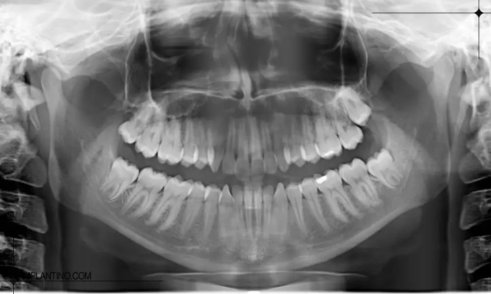 نمایش دندان ها در عکس opg