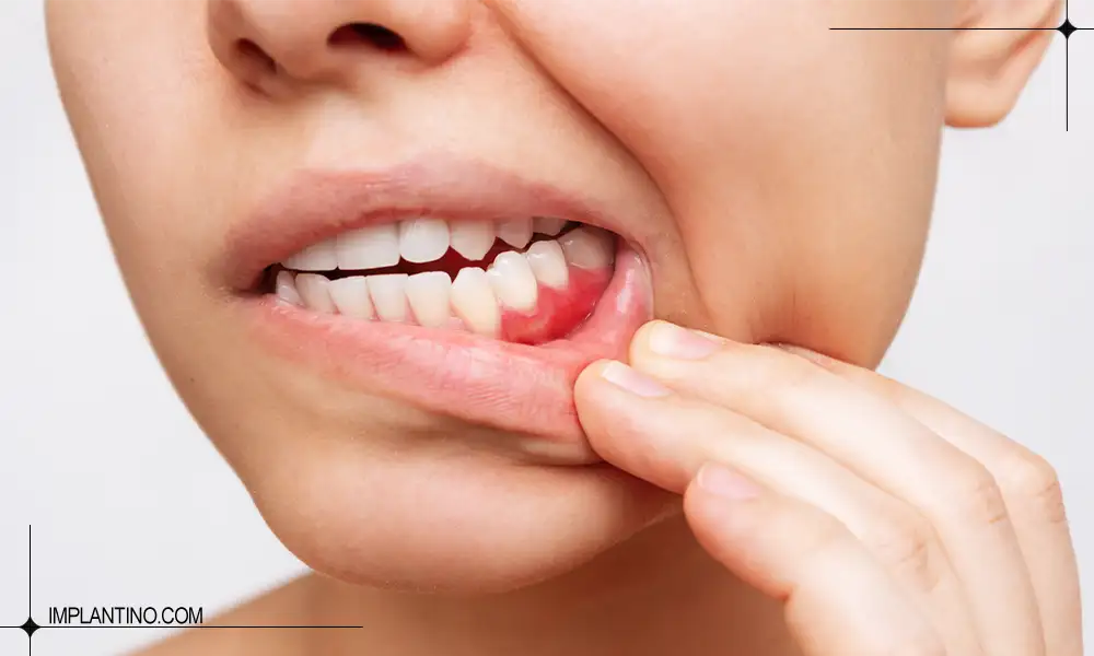 شناخت و درمان عفونت لثه 2 عفونت لثه در فک پایینی و دندان های آسیاب