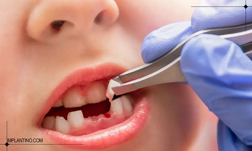 کشیدن دندان شیری چگونه است؟ 2 کشیدن دندان شیری