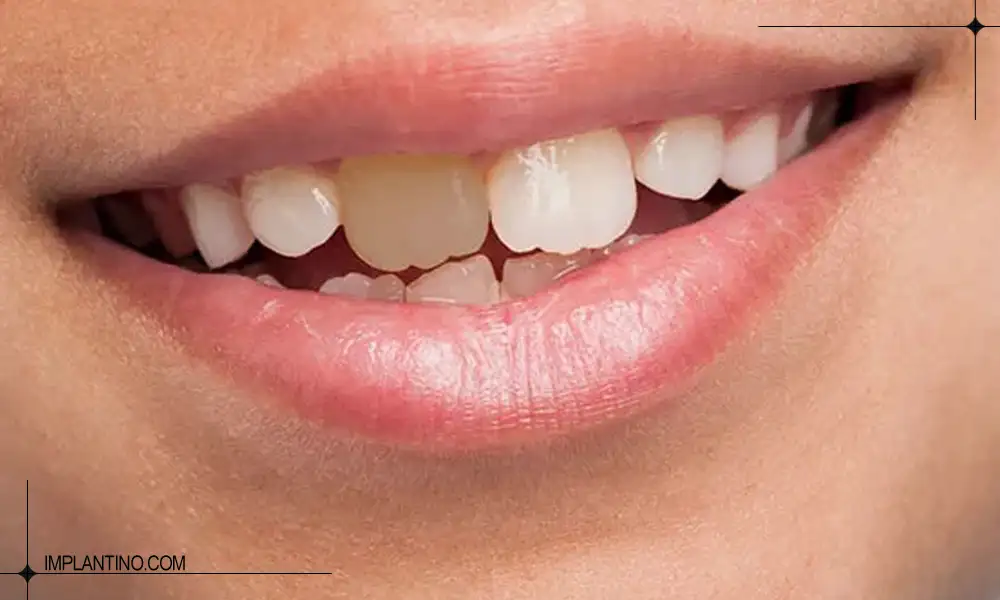 دلایل سیاه شدن دندان ها و راه های درمان 1 سیاه شدن دندان دندان نیش فک بالا