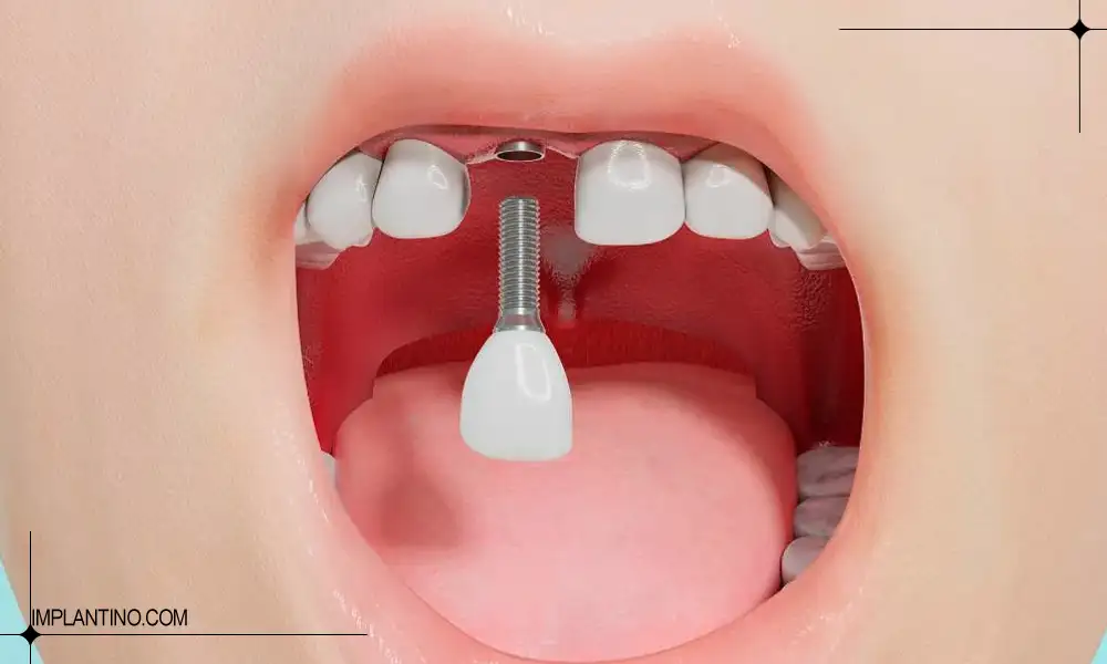 ایمپلنت تک دندان چگونه است؟ 2 ایمپلنت تک دندان