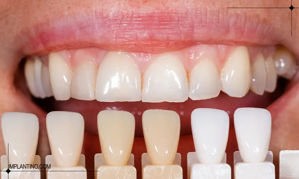 معرفی بهترین رنگ کامپوزیت دندان 3 چند نمونه از بهترین رنگ کامپوزیت دندان