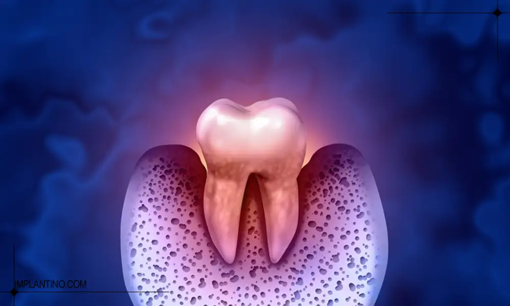 دلیل و شناخت عفونت دندان 2 شکل عفونت دندان