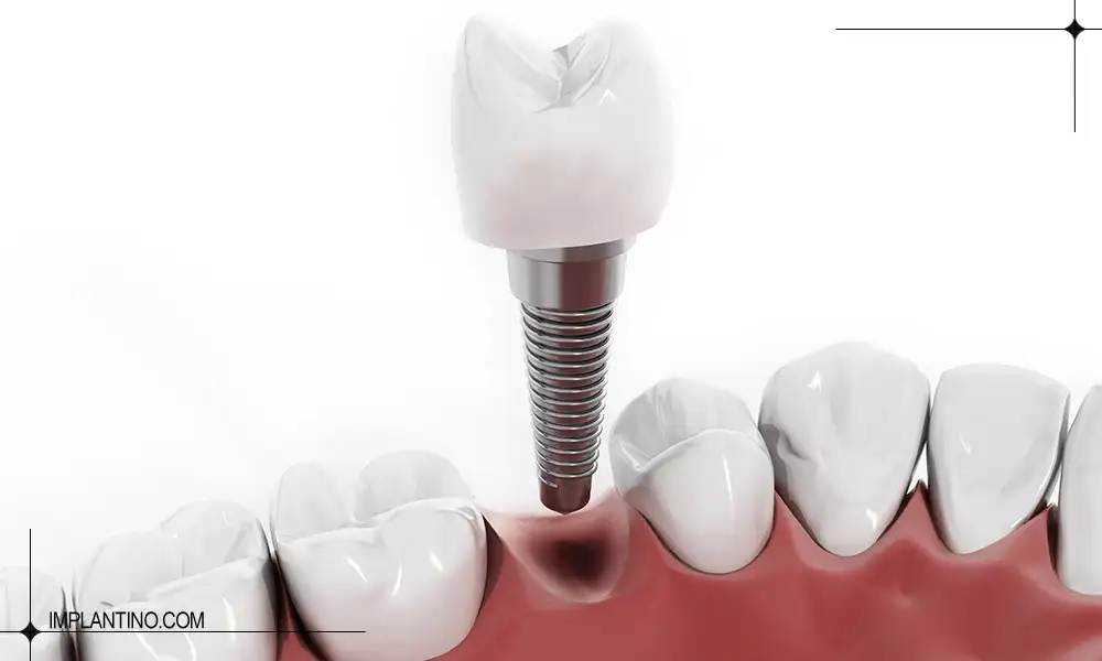 عکس لثه و ایمپلنت دندان آماده برای کاشت | حساسیت به ایمپلنت