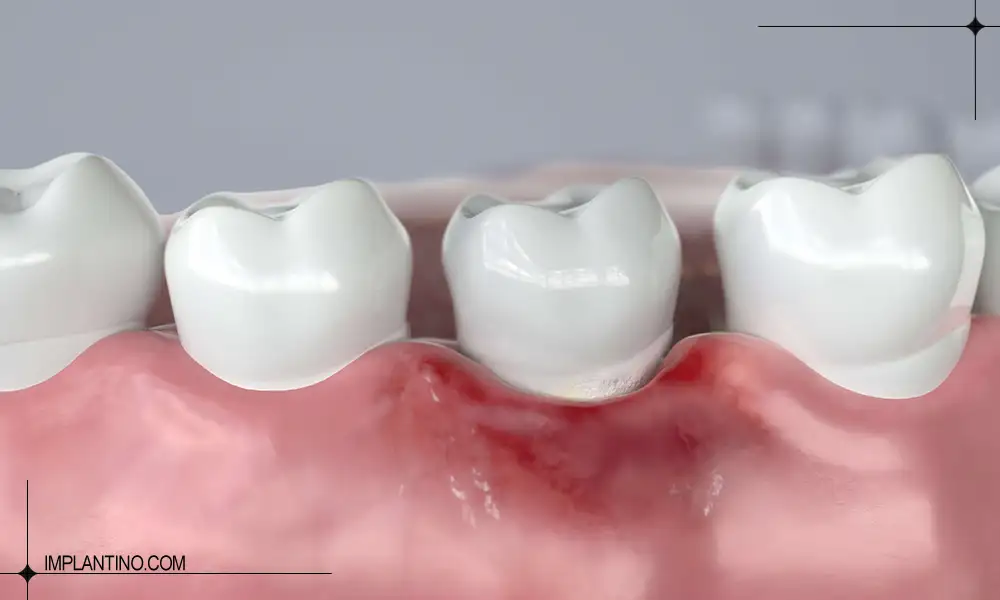 شناخت و درمان عفونت لثه 3 عکس قرمزی و تورم لثه در اثر عفونت لثه