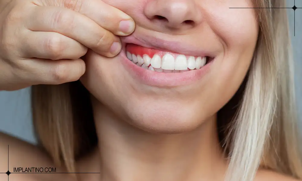 شناخت و درمان عفونت لثه 1 عفونت لثه در فک لالا که باعث قرمزی التهاب لثه شده است.