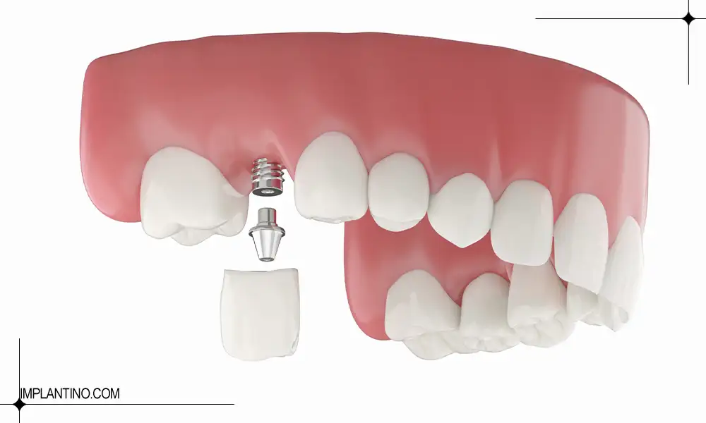 ایمپلنت تک دندان چگونه است؟ 1 قرار دادن ایمپلنت تک دندان