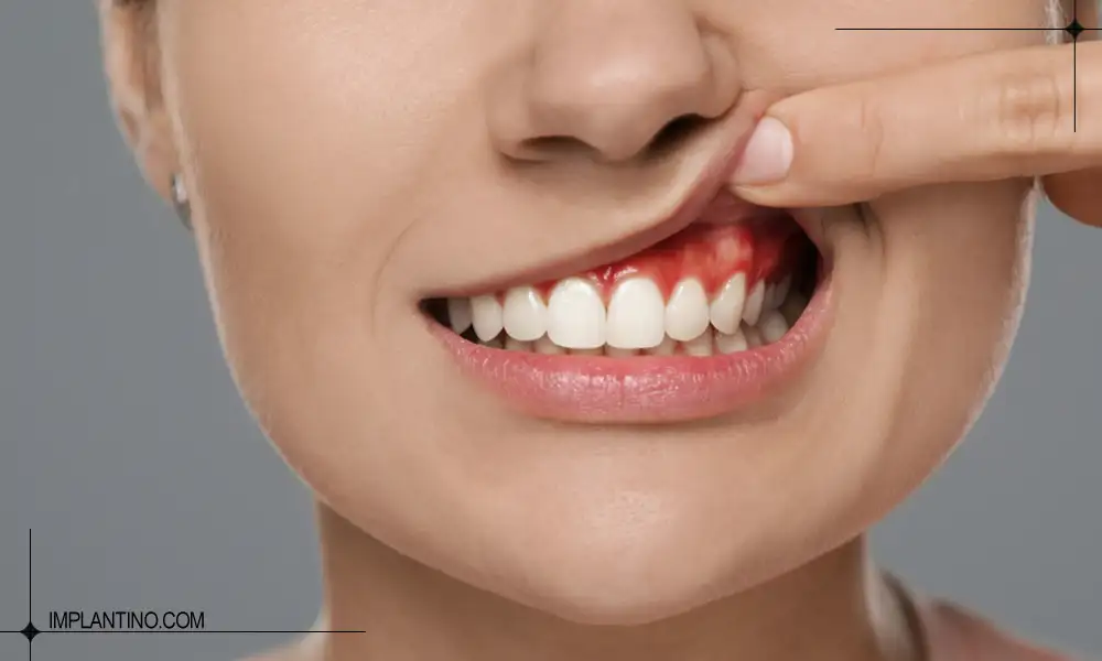 شناخت آبسه دندان و راه های درمان ان 1 آبسه دندان فک بالا