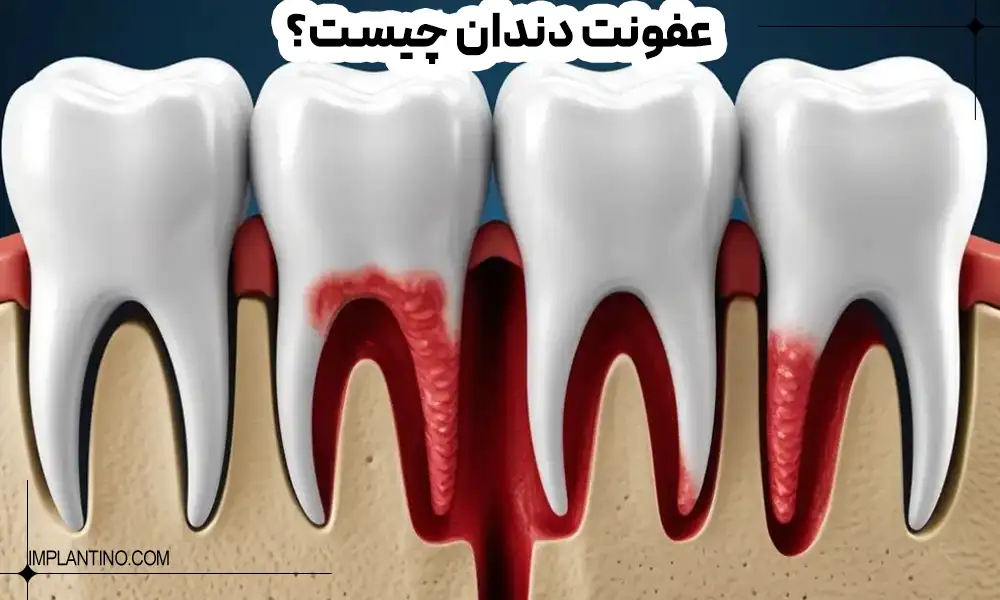 دلیل و شناخت عفونت دندان 1 چگونگی عفونت دندان