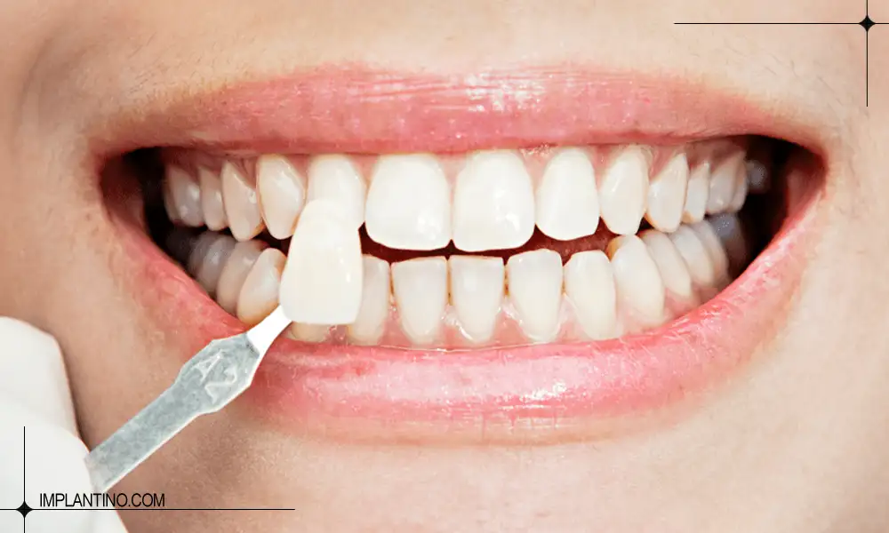 قرار دادن کامپوزیت شیشه ای دندان