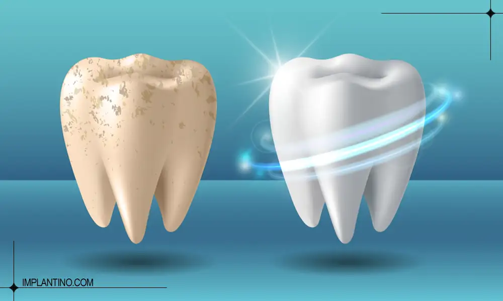 عکس مینای دندان خراب و سالم