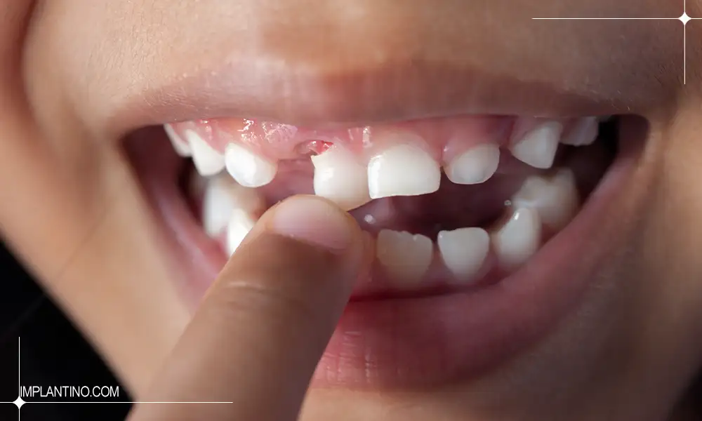 کشیدن دندان شیری چگونه است؟ 1 لق شدن و کشیدن دندان شیری