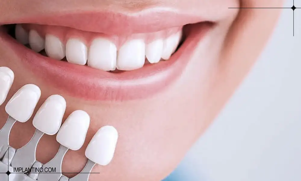 انتخاب رنگ برای کامپوزیت شیشه ای دندان