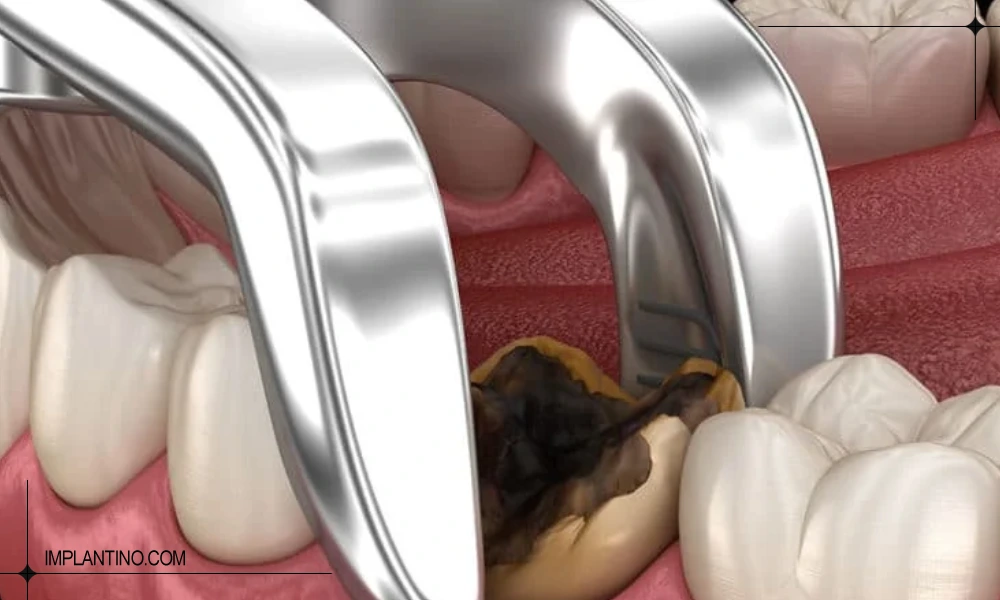 همه چیز درباره کشیدن دندان 2 کشیدن دندان