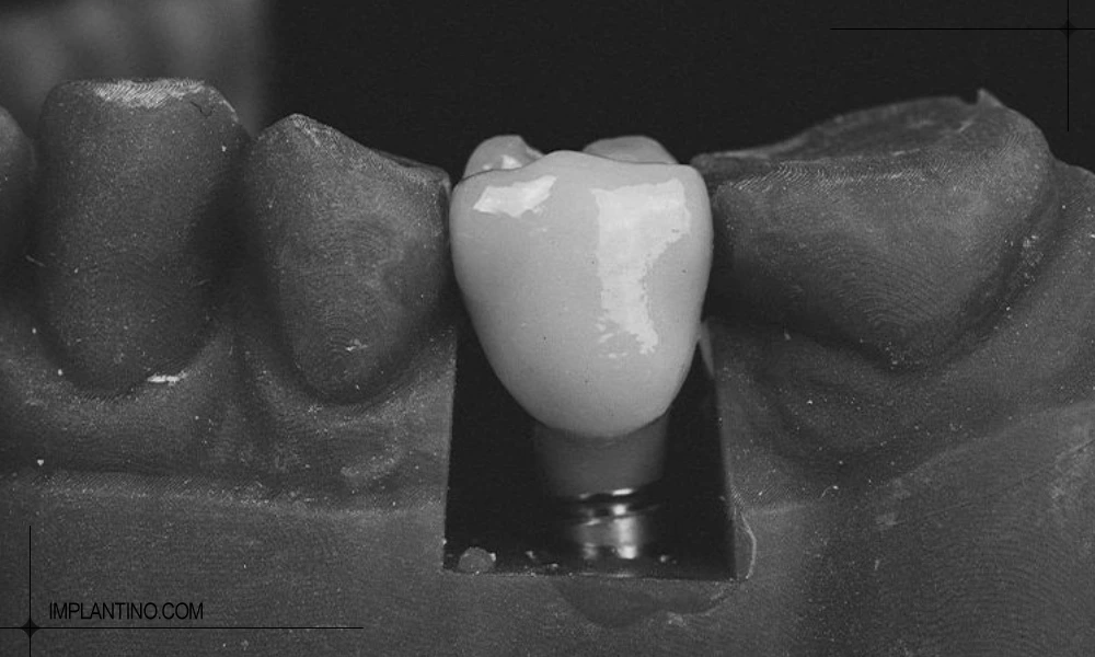 آشنایی با ایمپلنت آلمانی 2 ایمپلنت آلمانی
