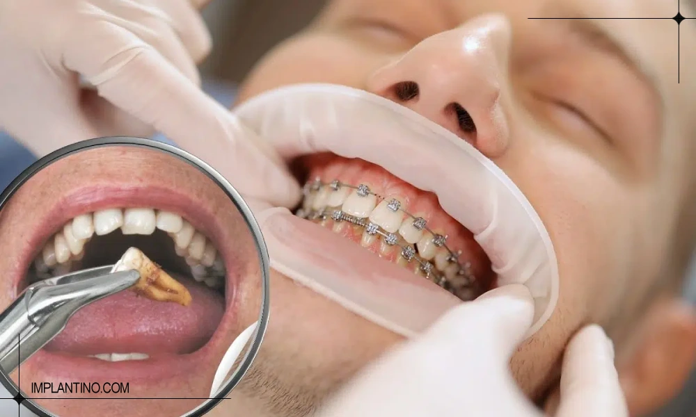 همه چیز درباره کشیدن دندان 1 کشیدن دندان