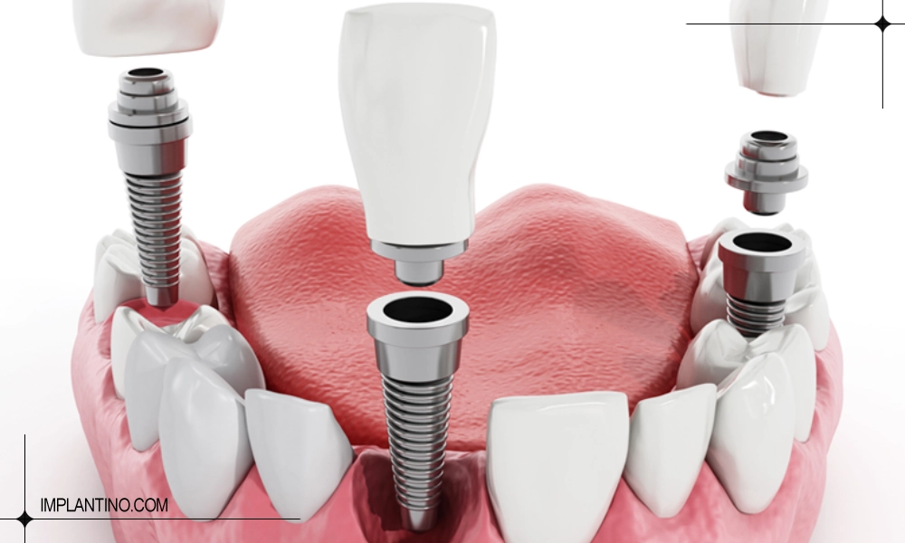 آشنایی با ایمپلنت آلمانی 1 ایمپلنت آلمانی