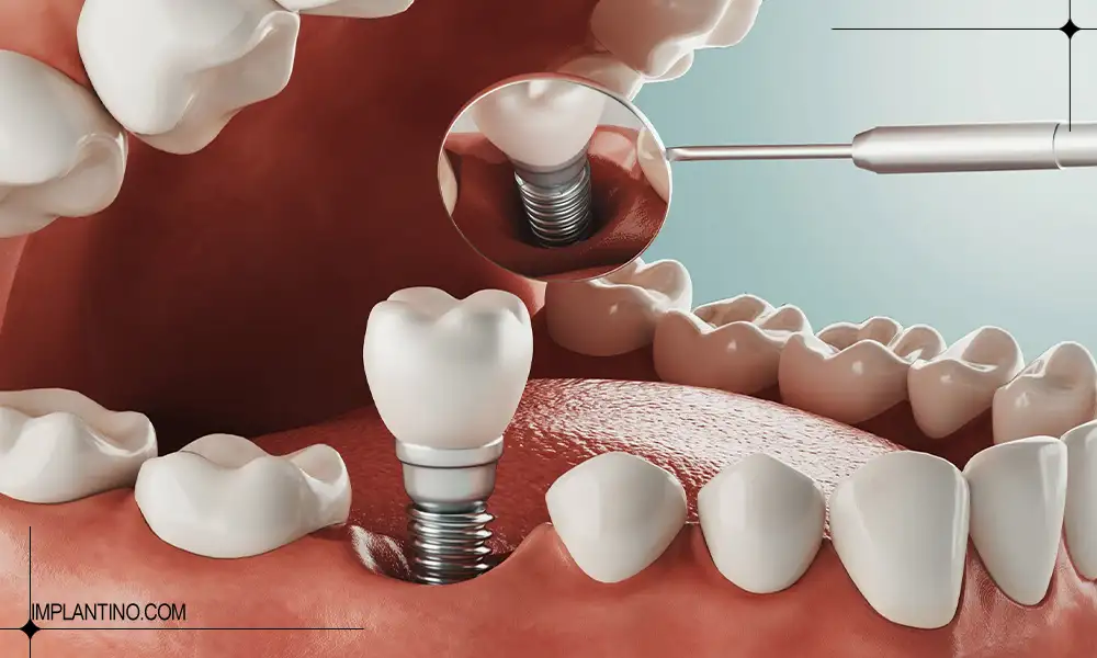 بررسی و آشنایی با مزایای ایمپلنت دندان 2 مزایای ایمپلنت دندان با کاشت دندان و راحتی تمام