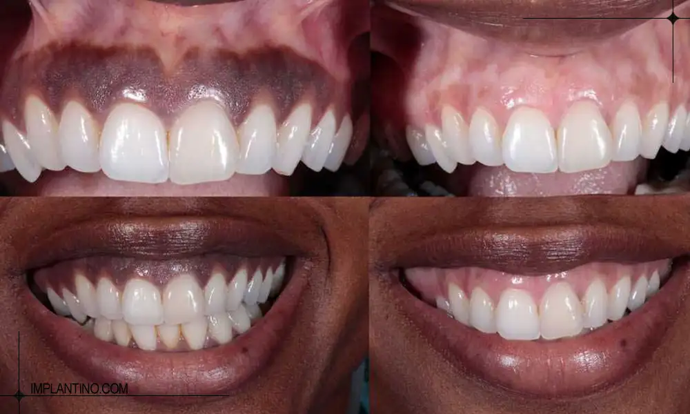 عکس قبل و بعد درمان تیرگی لثه