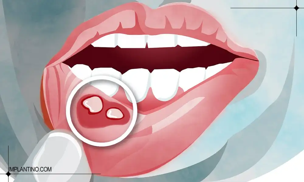 شکل آفت دهان