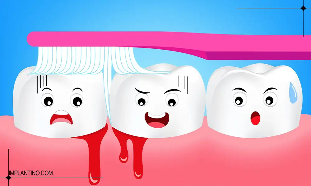 دلیل خونریزی لثه هنگام مسواک زدن 2 خونریزی لثه هنگام مسواک زدن دندان ها