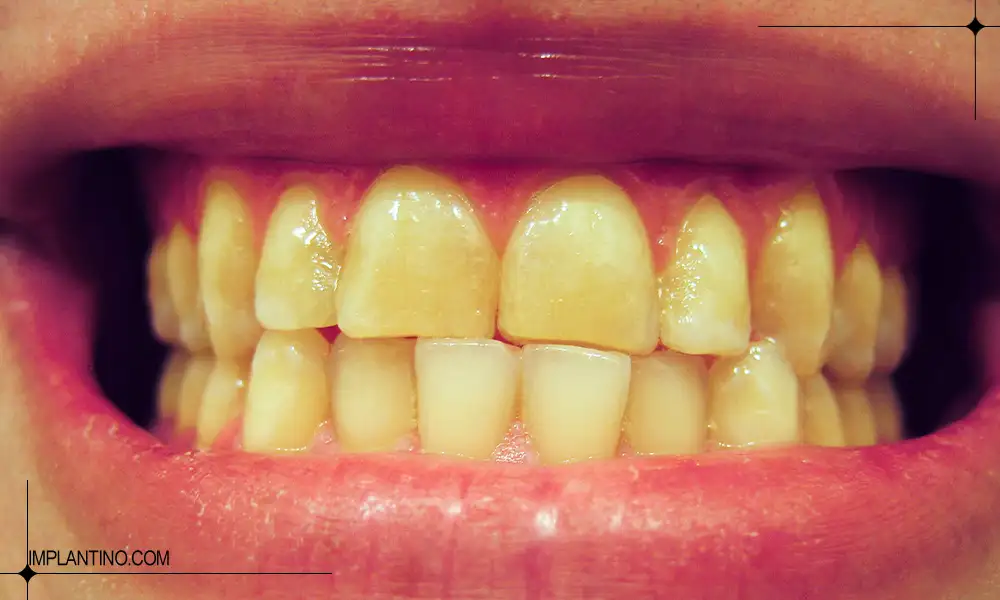 آشنایی دلایل زرد شدن دندان 2 زرد شدن دندان با خوردن قهوه